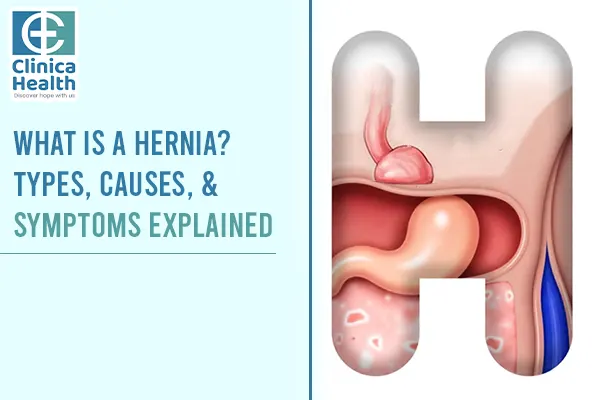 hernia