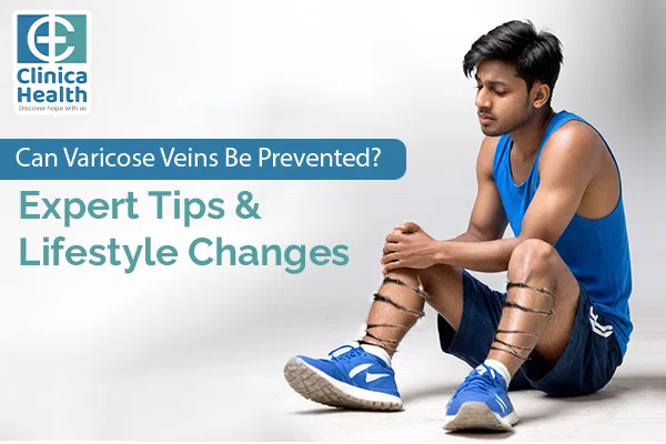 prevent varicose veins