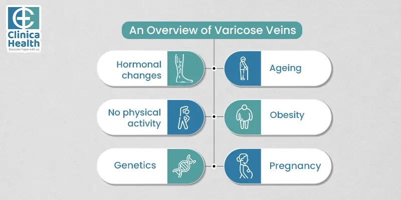 overview varicose veins