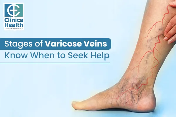 Stages of Varicose Veins