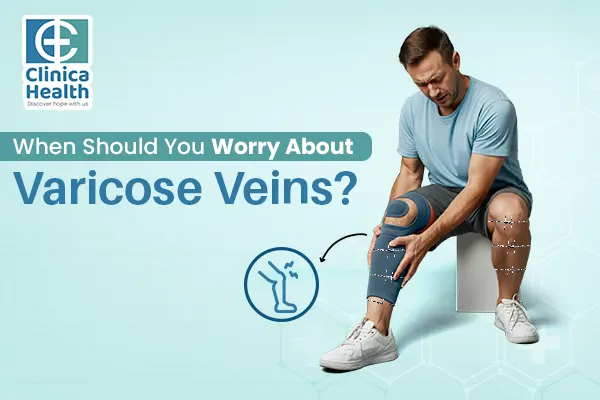 varicose veins