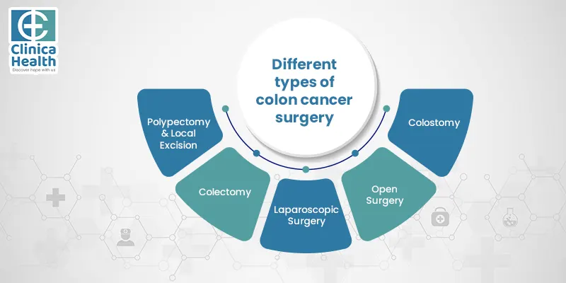 colon cancer surgery