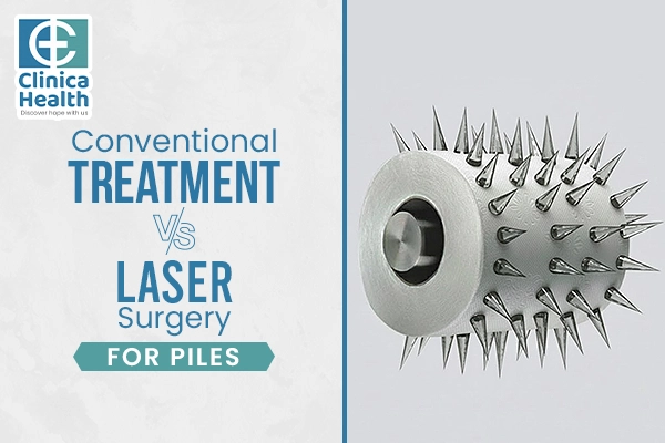 laser piles surgery in Kolkata