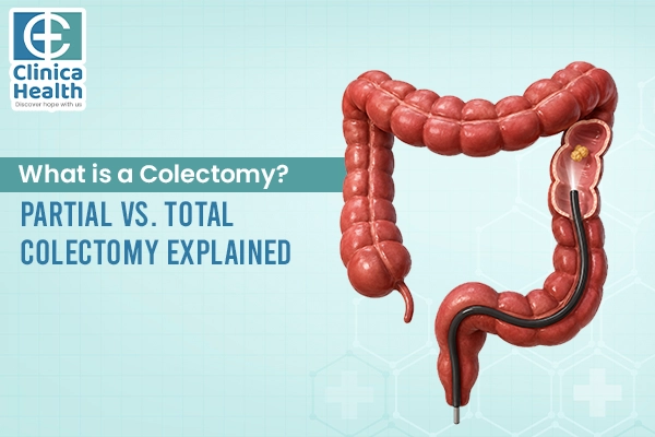 colorectal cancer surgery