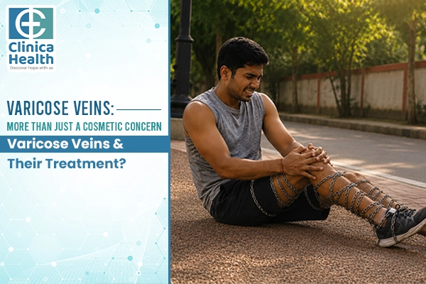varicose vein treatment
