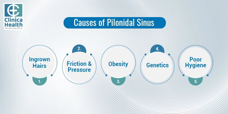 pilonidal sinus
