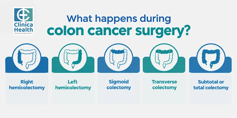 colon cancer surgery